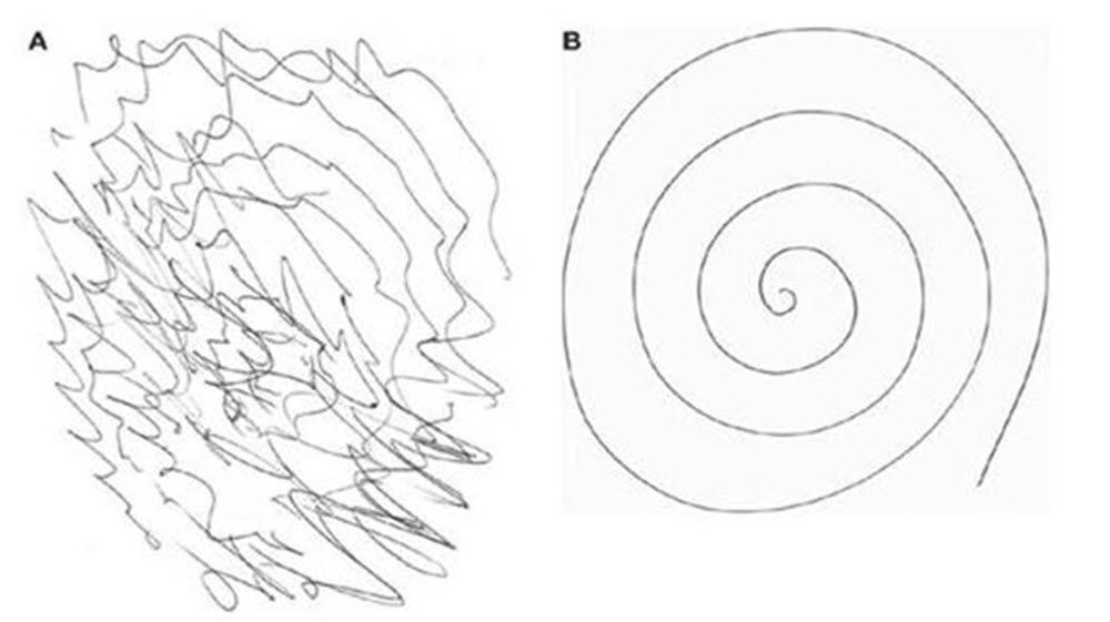 Эссенциальный тремор. Эссенциальный тремор спираль. Тест на эссенциальный тремор. Эссенциальный тремор рисование спирали. Эссенциальный тремор тест спирали.
